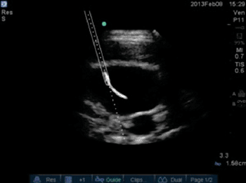 Imagen B: Se muestra la tecnología de guía durante el acceso vascular (Fotografía cortesía de SonoSite).